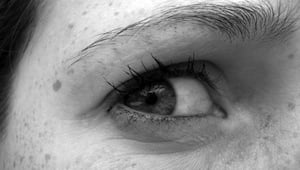 Tired of freckles on your face?